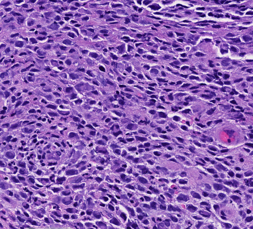 Janiranavarro's tweet image. GI-Unexpected Findings in Small Biopsies
Anal ulcer 78 yo Male

S100+, Melanoma..?
Case signed as Melanoma but molecular test showed BRAF mutation which is rare in mucosal melanomas
New stains: Langerin and CD1a positive...

Final Diagnosis: Langherhans cell hystiocytosis