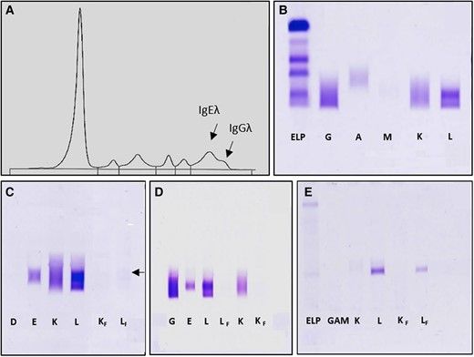 Clinical #Case Study: "An Unexpectedly High IgE Level during #Allergic Exploration"

by Guillaume Feugray &amp; others 

#MedTwitter #LabMedX

👉 buff.ly/4hjBYvn 

Commentaries:
Louis Nevejan &amp; Xavier Bossuyt:buff.ly/3CvtNNz 
Rebecca Treger: buff.ly/4jSXGrV