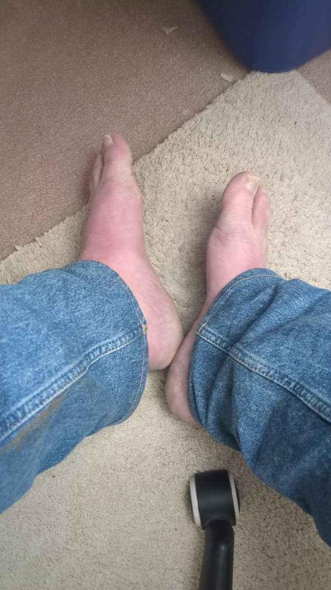 Day 5, big toe nails cut but otherwise still dry AF