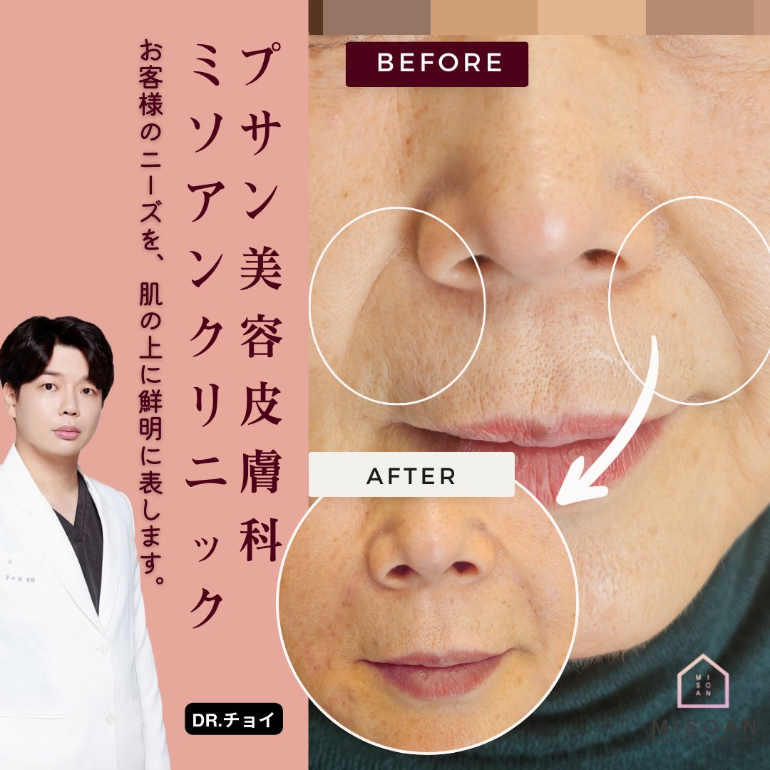 あなたが求める美しさを思いのままにデザイン✨

頬のたるみ、皮膚のハリ不足 ▶️ シワ改善フィラー
顔の特徴を考慮し、適切な量を使用したオーダーメイドデザイン
