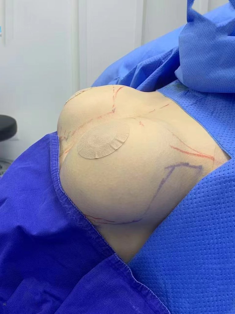 小姐姐之前做过一次胸出现包膜挛缩，一边胸部挛缩发硬，做的修复胸#泰国隆胸