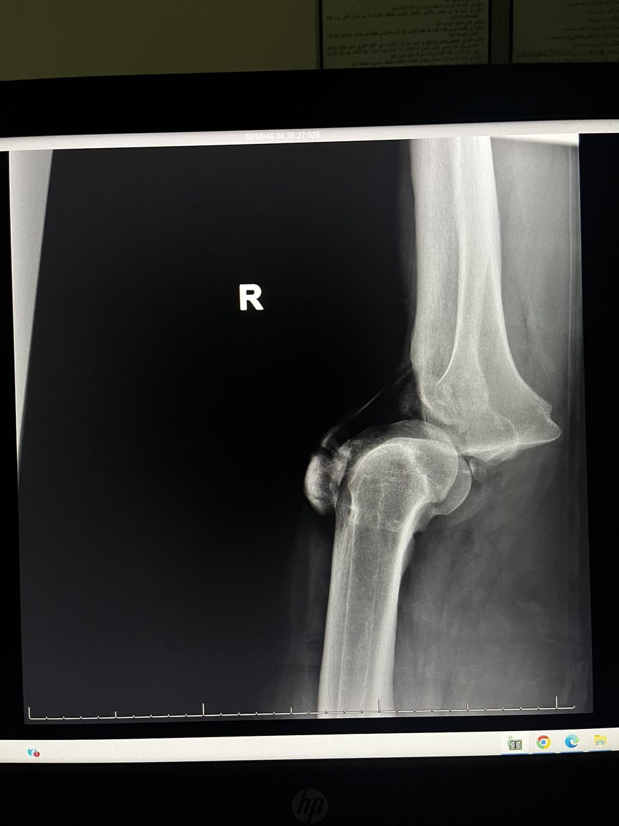 AldeayaAz's tweet photo. Patient came to ER who was hit by a car while walking . He suffered a knee dislocation . We did an emergency surgery. 
X-Ray images before and after surgery showing the injury and intervention https://t.co/08dLATv7Ke