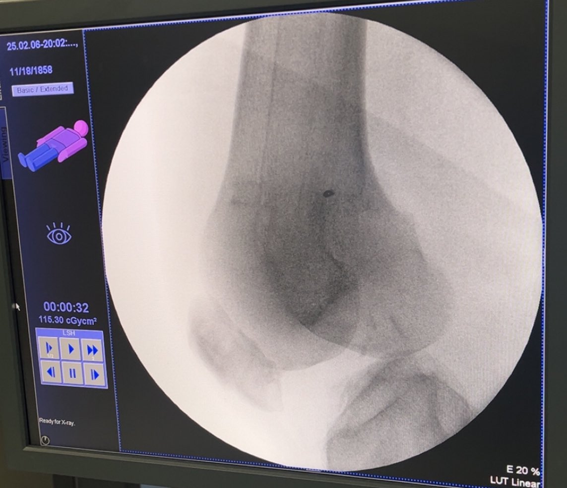 AldeayaAz's tweet photo. Patient came to ER who was hit by a car while walking . He suffered a knee dislocation . We did an emergency surgery. 
X-Ray images before and after surgery showing the injury and intervention https://t.co/08dLATv7Ke