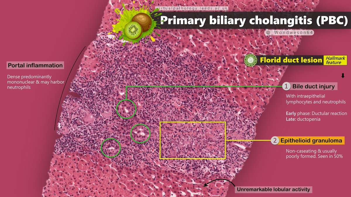 [Primary Biliary Cholangitis]
❶ Autoimmune, 85% 👩
❷ TRIADS: Cholestasis | Circulating Anitmitochondrial antibodies (+95%) | Nonsupurative destructive cholangitis
❸ 🩺: Fatigue, pruritis, jaundice
❹ 💊: Ursodeoxycholic acid 
<a href="/Pathologists/">CAPathologists</a> #Pathresidents #PathX #MedTwitter