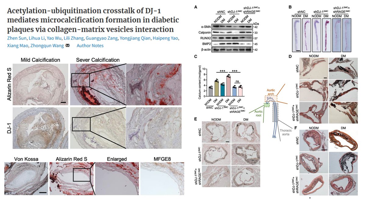 HaoYin20's tweet photo. DJ-1/PARK7 (one causal gene of early-onset #ParkinsonDisease) protects against Diabetic #VascularCalcification
Acetylation (by NAT10)-Ubiquitination (by TRIM32) cascade degrades DJ-1▶️
⏫STAT1 & RAGE
⏫#SmoothMuscleCell Osteogenic phenotype
⏫SMC-derived MFGE8+ #MatrixVesicle▶️
⏫MV-collagen physical binding
#CardiovascRes 2024 @ESC_Journals
https://t.co/oVldYmWVZ2