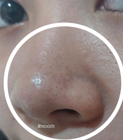 ⚠️ CW// KOMEDO

akhirnya nemu cara cepet ilangin strawberry nose alias komedo di idung yang selama ini membandel &amp; ganggu bgt🥹🫶🏻

ini sekali pemakaian yaa, bukan pake masker komedo tapii..👀⁉️

                    from this                          to this