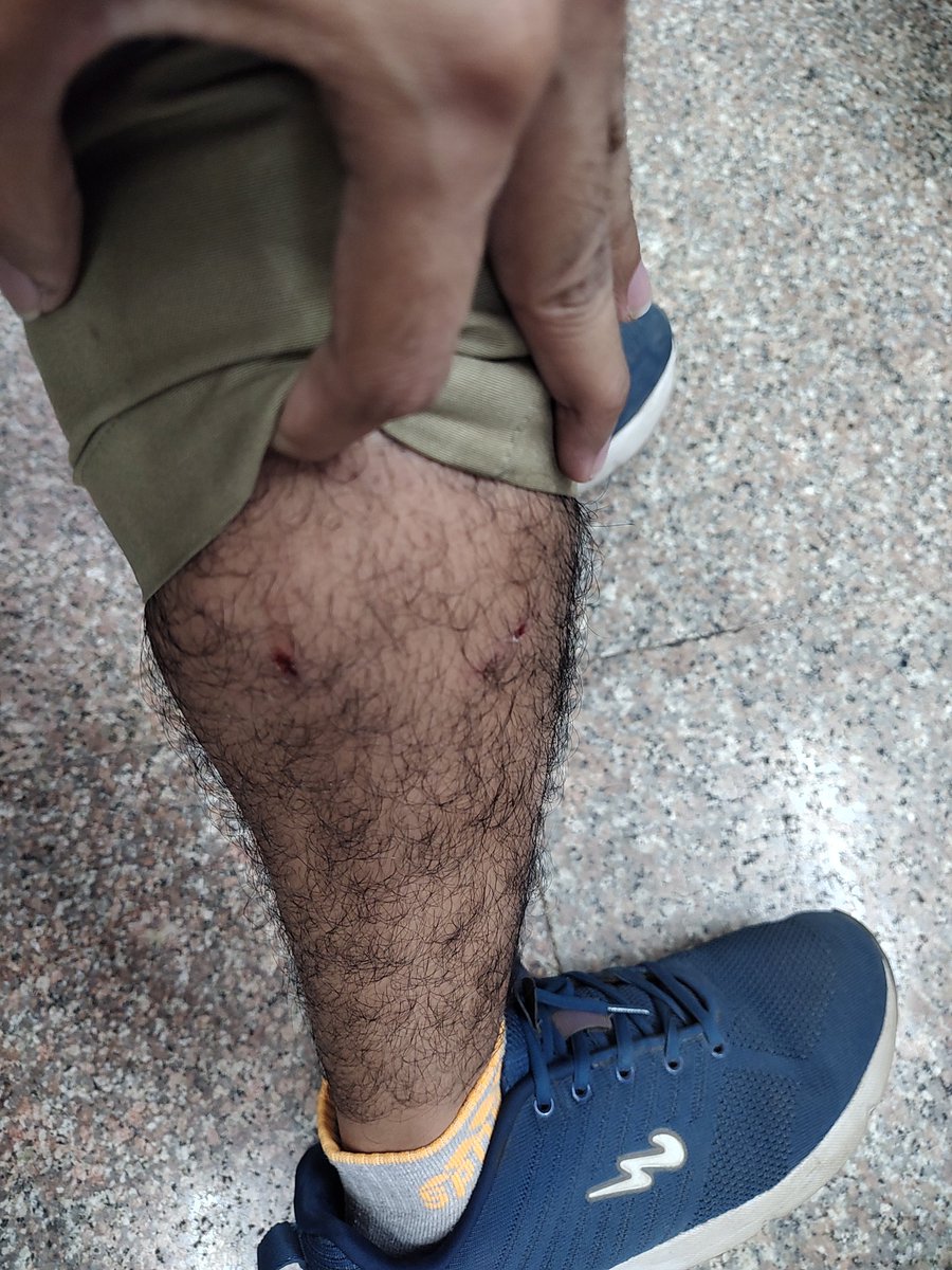 ab_margaj's tweet photo. @mybmcWardT
@mybmc
I'm Postman Arjun Margaj. I was bitten by a stray dog at Mukund Society Gawanpada Mulund East today while I was on duty. I've included a picture of that dog below. I request BMC take the necessary action to stop this stray dog from attacking civilians in future https://t.co/t28xnu4miG