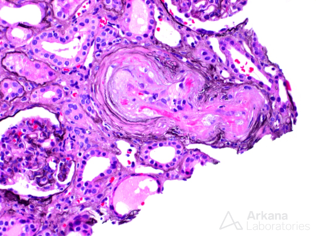 arkanalabs's tweet image. What is your diagnosis?

#DiagnoseThis #renalpath #nephropath