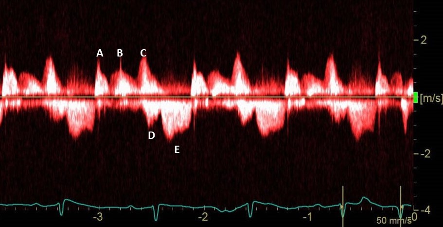 A patient in ICU. CW Doppler interrogation is performed across the mitral valve in 4-chamber view. What are the waves labeled A-E  and what are the hemodynamic implications?