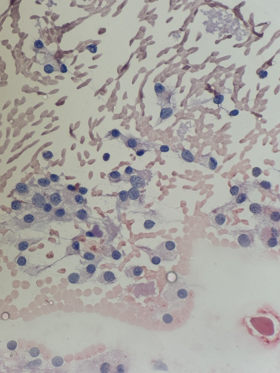 Andresangel3's tweet image. #Cytopath #FNApath Middle age man with FNA thyroid nodule. Opinion ?