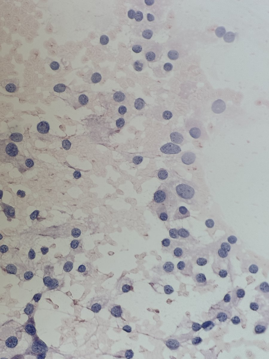 Andresangel3's tweet image. #Cytopath #FNApath Middle age man with FNA thyroid nodule. Opinion ?