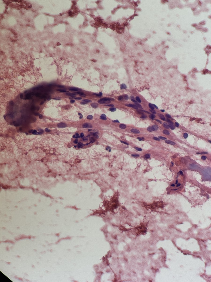 Andresangel3's tweet image. #Cytopath #FNApath Middle age man with FNA thyroid nodule. Opinion ?