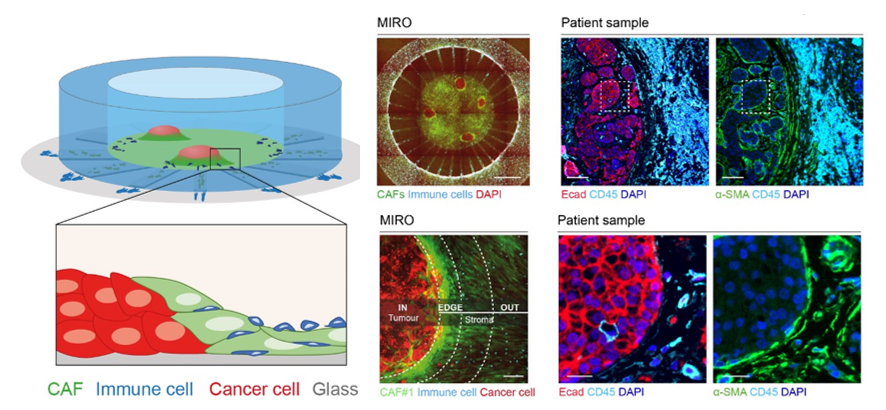 PeruccaAlice's tweet photo. 2/7: MIRO is an open fluidic device that models the tumour-stroma interface using patient-derived cells. This allows us to recreate aspects of the #TumorMicroenvironment and study immune interactions in the lab. 🔎🧫 #Microfluidics #OnChip https://t.co/kkhAcJMP9v