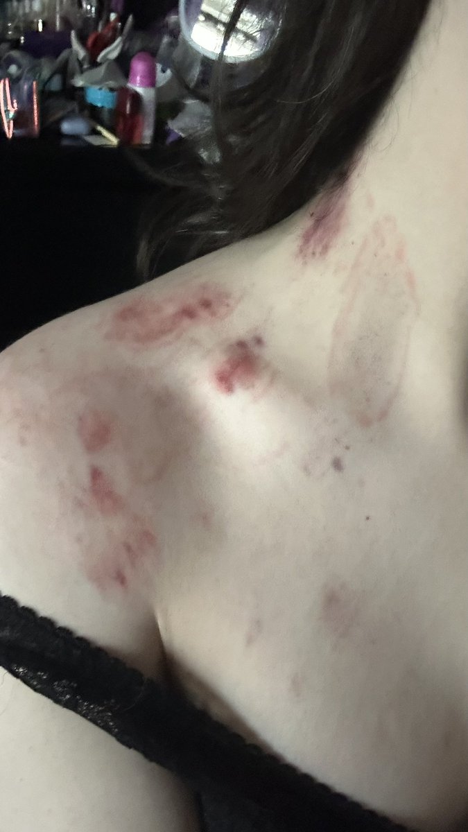 squishynip's tweet photo. gf told oomf to bite the fuck out of me, and they sure did 🫠 https://t.co/h43cz4vGWy