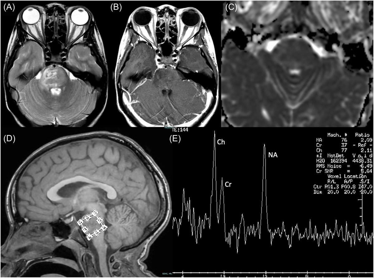 Vivien X. Xie &amp; colleagues at <a href="/ChildrensNatl/">Children's National Hospital 🏥</a> present a novel example of pediatric NMOSD &amp; autoimmune GFAP astrocytopathy overlap syndrome originally presenting as an infiltrative pontine mass. Read more for free: onlinelibrary.wiley.com/doi/10.1002/cn…

@WileyNeuro <a href="/BenSiegelMD/">Ben Siegel</a> #neuroimmunology