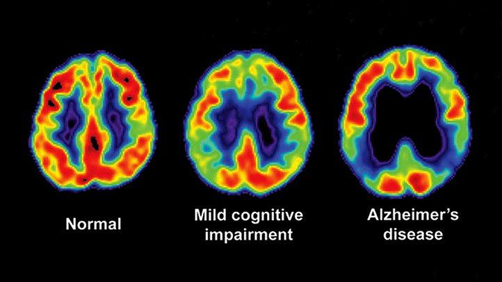 Forget everything you know about Alzheimer's:

Only 5% of cases are genetic.

The remaining 95% of cases are linked to one thing.

It's not what doctors have been telling us for decades.

Here's the disturbing truth about what really causes Alzheimer's: