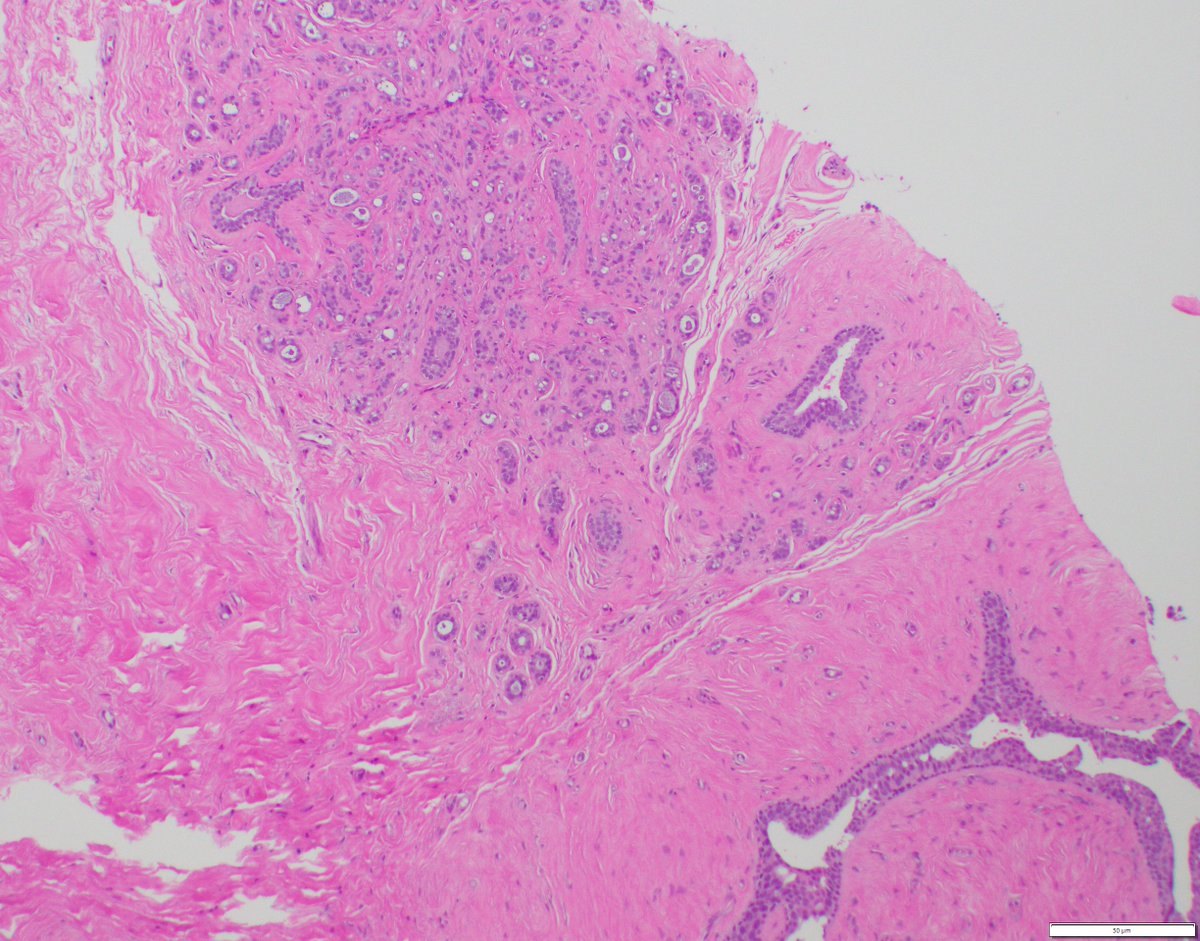 Complex fibroadenoma with sclerosing adenosis.
#breastpath #pathresidents #pathtwitter #BreastPatholog1
<a href="/ColumbiaPath/">Columbia Pathology</a> @Columbiapathres <a href="/TheISBP/">ISBP</a>