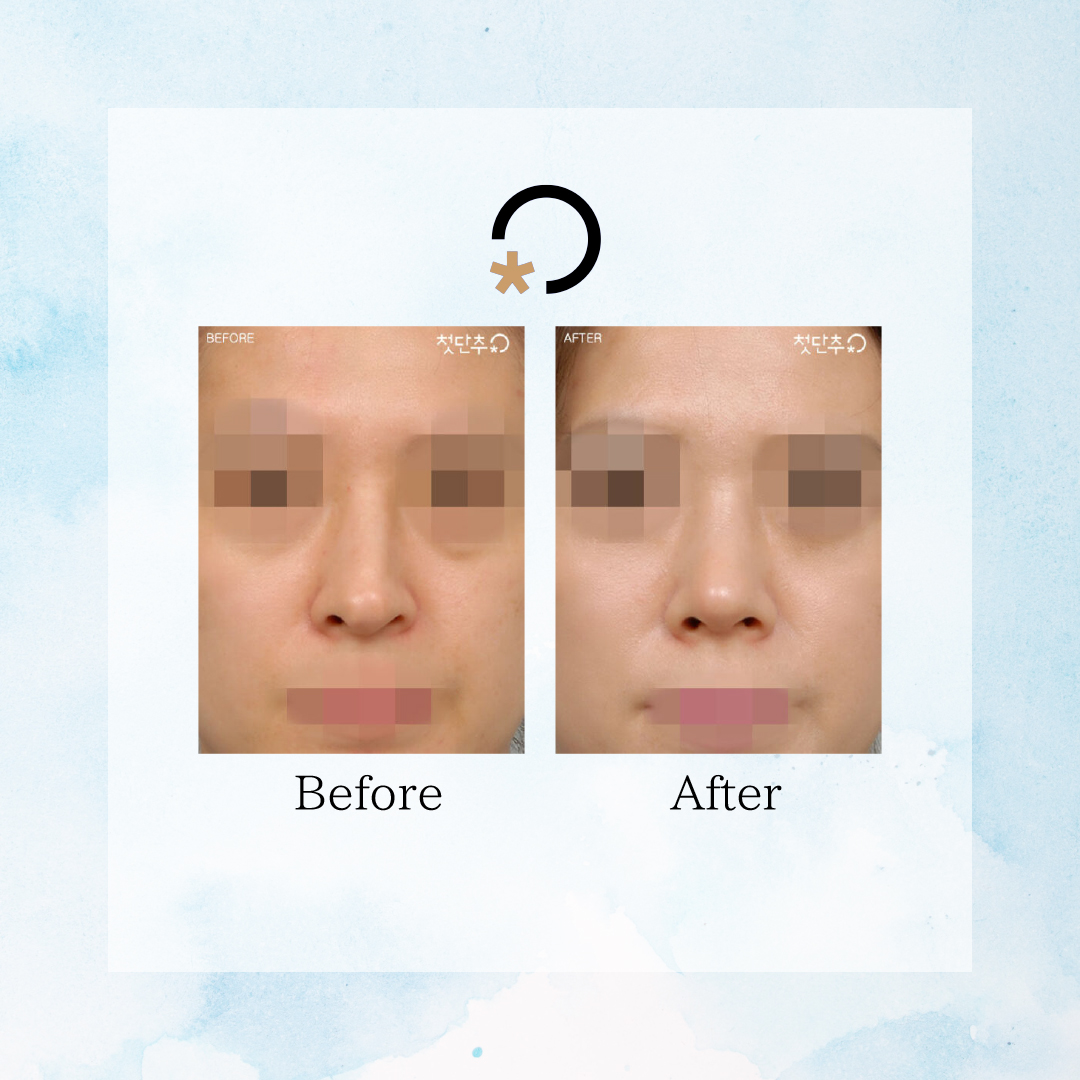 1stbutton_jp's tweet photo. 📢 鼻のプロテーゼが歪んでしまったら？原因＆解決策！ 👃💡

プロテーゼのズレや傾きが気になる方必見⚠️
原因＆予防策をチェック！ ✅
🔎 プロテーゼが歪む原因
1️⃣ 非開放型手術 → 位置調整が難しくズレやすい
2️⃣ 開放型手術でのミス → 骨格の非対称を修正しないと片側に寄る
3️⃣ 鼻先の手術不足 → 固定が不十分で傾く

💡 解決方法
✔ プロテーゼの端を調整し、正しく固定
✔ 骨格を平坦にし、左右のバランスを調整
✔ 鼻筋軟骨とプロテーゼを縫合してズレを防ぐ
🚨 予防策も重要！
☑ 手術後4週間は衝撃NG
☑ 横向き寝やメガネ使用を避ける
☑ 強くこすらず、定期的にチェック
もしプロテーゼのズレが気になるなら、まずは相談を！👨‍⚕️✨
https://t.co/Z07NVPeqFF
https://t.co/kzECGsTu2d

#鼻整形 #プロテーゼ #鼻の歪み #美容整形 #韓国美容 #鼻手術 #鼻プロテーゼ #鼻整形後ケア