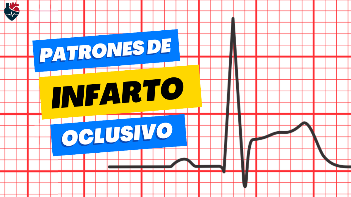 CardioNotion (@cardionotion) on Twitter photo ¿Sabías que el infarto oclusivo NO siempre presenta un supradesnivel del ST clásico?
Existen patrones sutiles que indican oclusión coronaria 🚨
Te invito a descubrirlos en este hilo 🧵👇
#CardioEd #MedEd #FoaMed #MIR #ENARM <a href="/cardiotipss/">Cardiotipss</a> ¿Sabías que el infarto oclusivo NO siempre presenta un supradesnivel del ST clásico?
Existen patrones sutiles que indican oclusión coronaria 🚨
Te invito a descubrirlos en este hilo 🧵👇
#CardioEd #MedEd #FoaMed #MIR #ENARM <a href="/cardiotipss/">Cardiotipss</a>