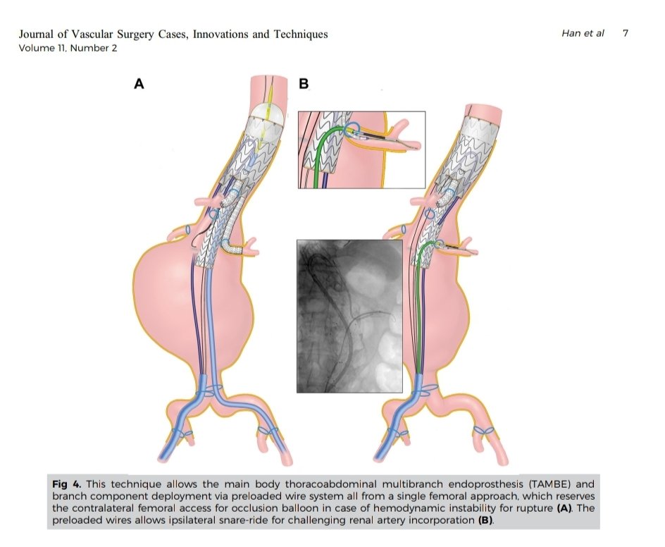 Hot off the press:

Technique paper in <a href="/JVascSurgCIT/">JVS-Cases Innovations and Techniques</a> by <a href="/SukguH/">Sukgu Han</a>, <a href="/IEMcElroy/">I E McElroy MD, MPH: @iemcelroymd.bsky.social</a>, and <a href="/GustavoOderich/">Gustavo Oderich</a> on using #TAMBE in ruptured complex AAA with temporary aortic balloon occlusion.
#aortaed #rAAA 
<a href="/KeckMedicineUSC/">Keck Medicine of USC</a>

jvscit.org/article/S2468-…