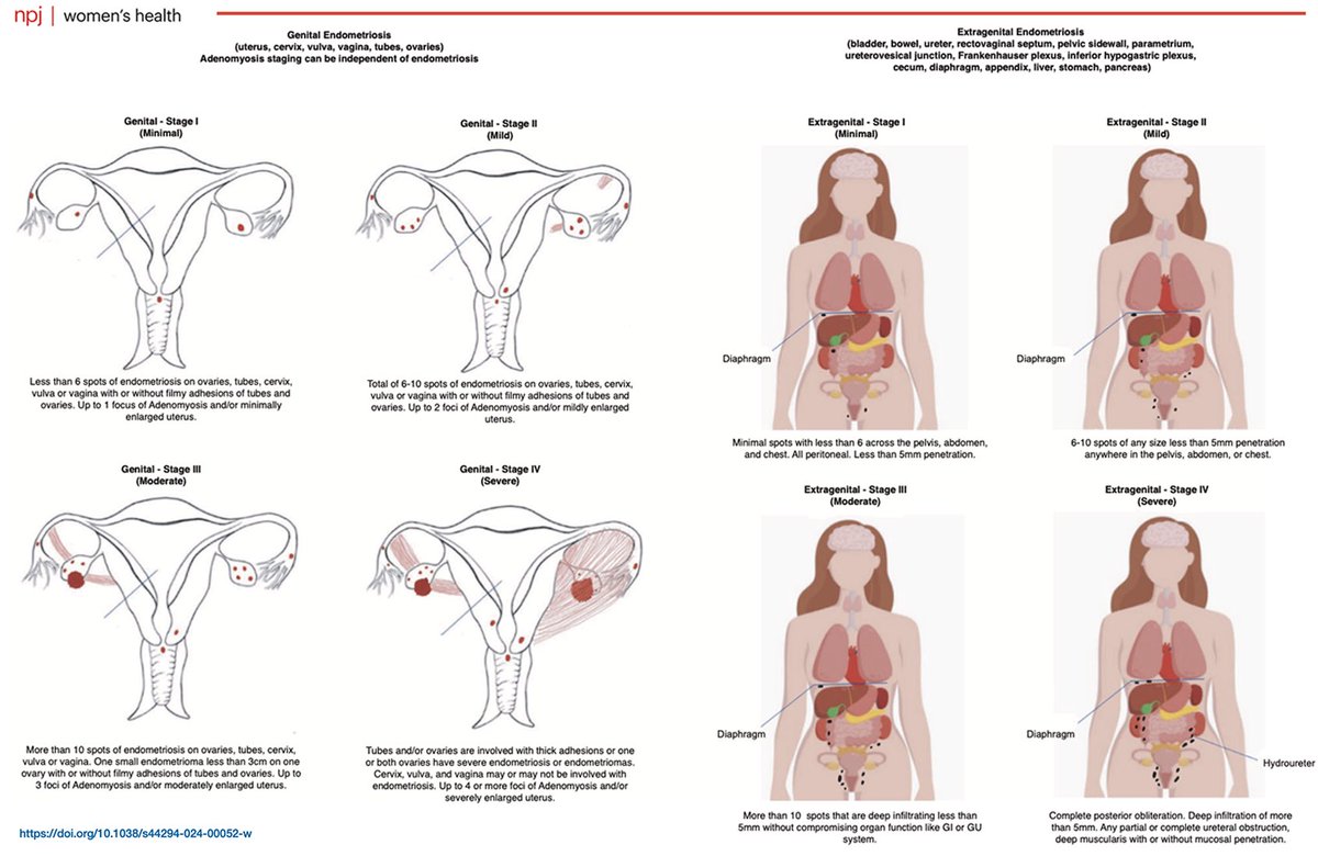 "The integration of artificial intelligence with omics data and health records holds promise for advancing our understanding and management of endometriosis." Read more here: rdcu.be/d8NSN 

#endometriosis #research
