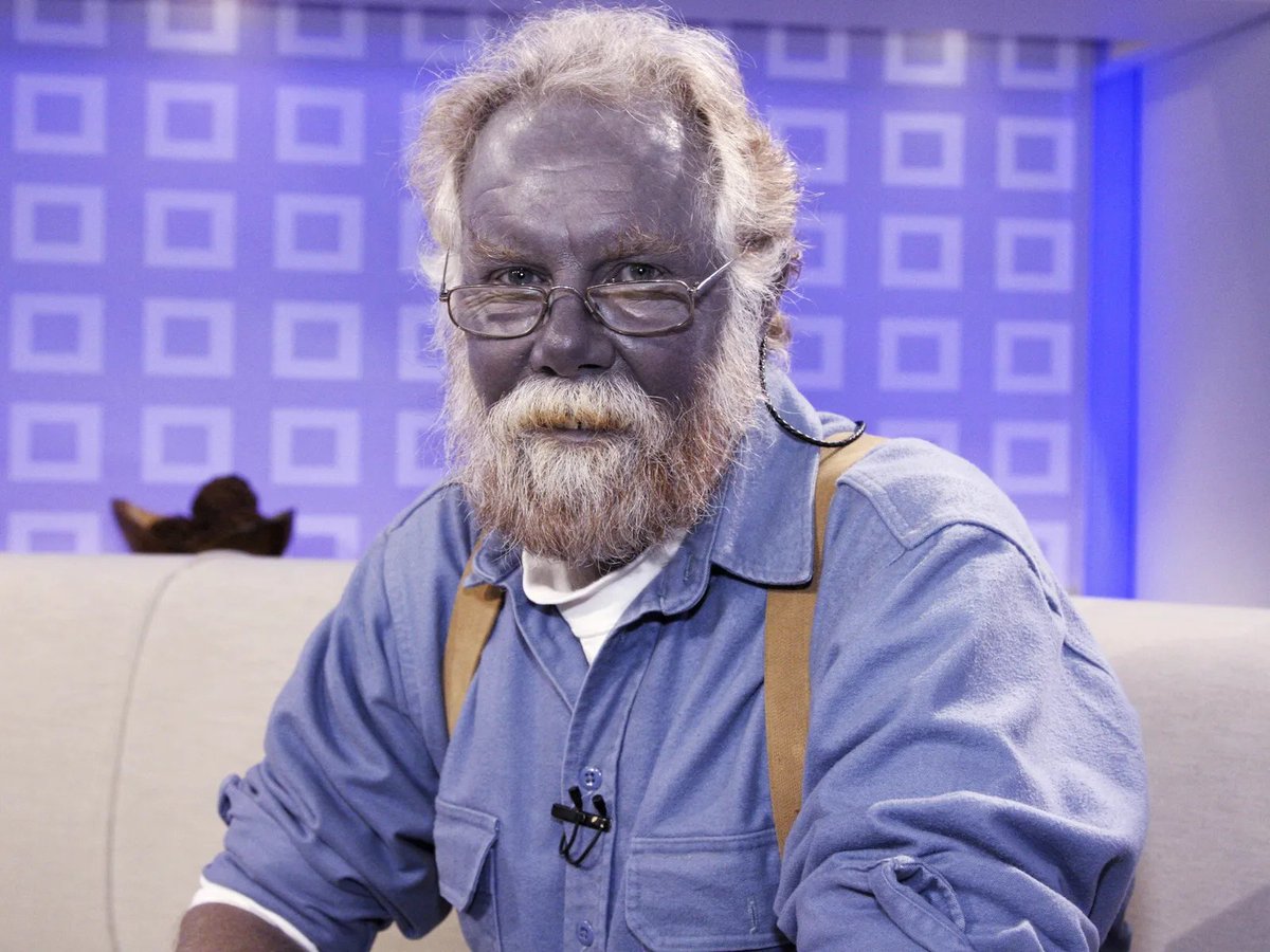 BlindIndex's tweet image. Paul Karason spent years drinking homemade colloidal silver, eventually turning his skin a permanent shade of blue. The rare condition, known as argyria, was caused by silver buildup in his body

his striking appearance made him go viral, but the health risks were real. Though he…