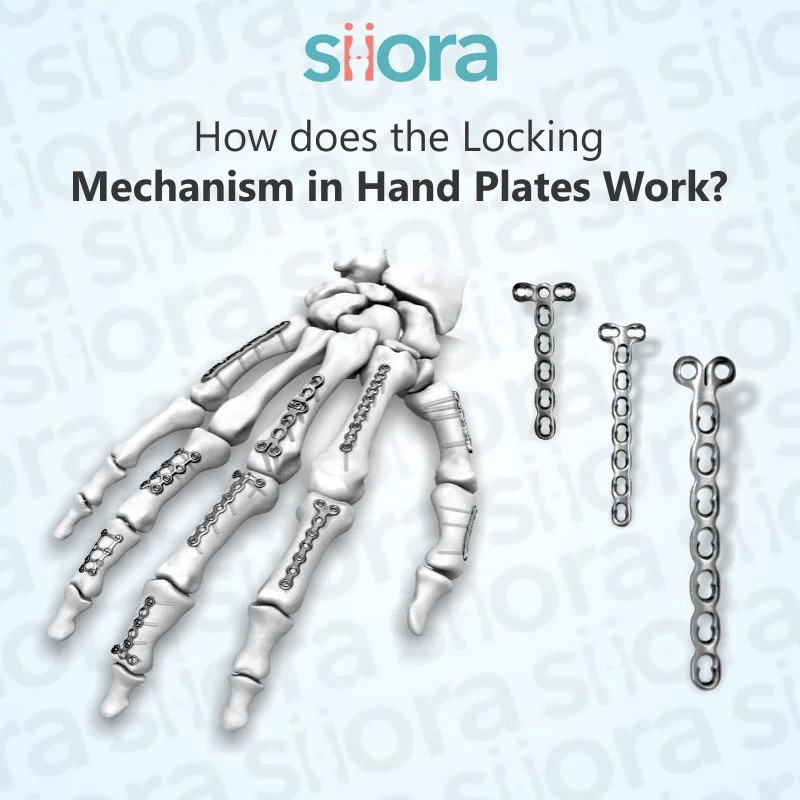 siorasurgicals's tweet image. In this blog, we will delve into the working principles of the locking mechanism in orthopedic hand plates, how it benefits patients, and why it is preferred over conventional fixation techniques.
siiora.com/blogs/locking-…
#LockingPlates #BoneStabilization #HandFracture #TraumaCare
