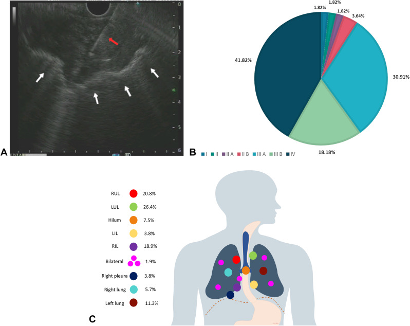 GIE (@gie_journal) on Twitter photo In Focused Communications, Rizzo et al focus on "EUS-guided transesophageal fine-needle biopsy sampling of lung masses: diagnostic performance and safety." giejournal.org/article/S0016-…
#GITwitter #GIEJournal
<a href="/BilalMohammadMD/">Mohammad Bilal, MD</a> In Focused Communications, Rizzo et al focus on "EUS-guided transesophageal fine-needle biopsy sampling of lung masses: diagnostic performance and safety." giejournal.org/article/S0016-…
#GITwitter #GIEJournal
<a href="/BilalMohammadMD/">Mohammad Bilal, MD</a>