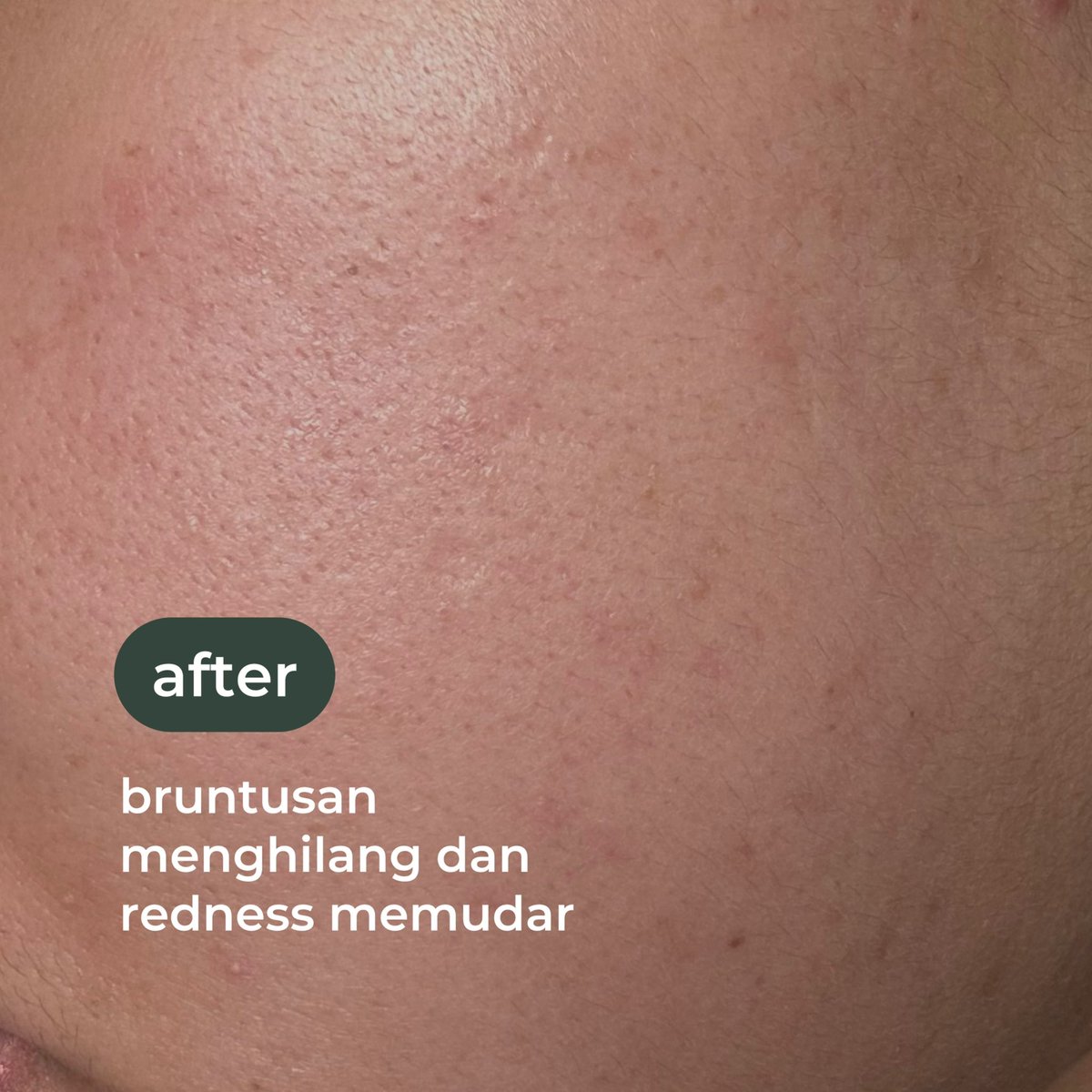 sukaskincarean's tweet image. kemarin habis gak cocok sama skincare dan kulitku muncul bruntusan kecil-kecil dan kemerahan. 

kalo udah kayak gini, skincare routine andalan aku adalah salicylic acid serum + calming moist. 3 harian pakai, langsung gone 👍🏻