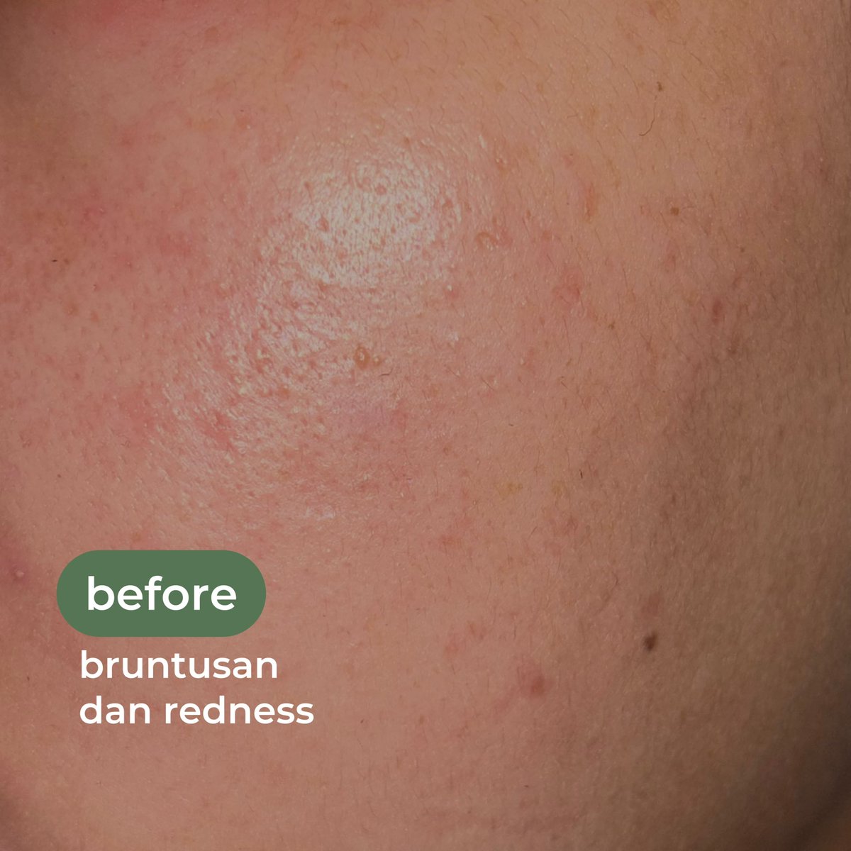 sukaskincarean's tweet image. kemarin habis gak cocok sama skincare dan kulitku muncul bruntusan kecil-kecil dan kemerahan. 

kalo udah kayak gini, skincare routine andalan aku adalah salicylic acid serum + calming moist. 3 harian pakai, langsung gone 👍🏻