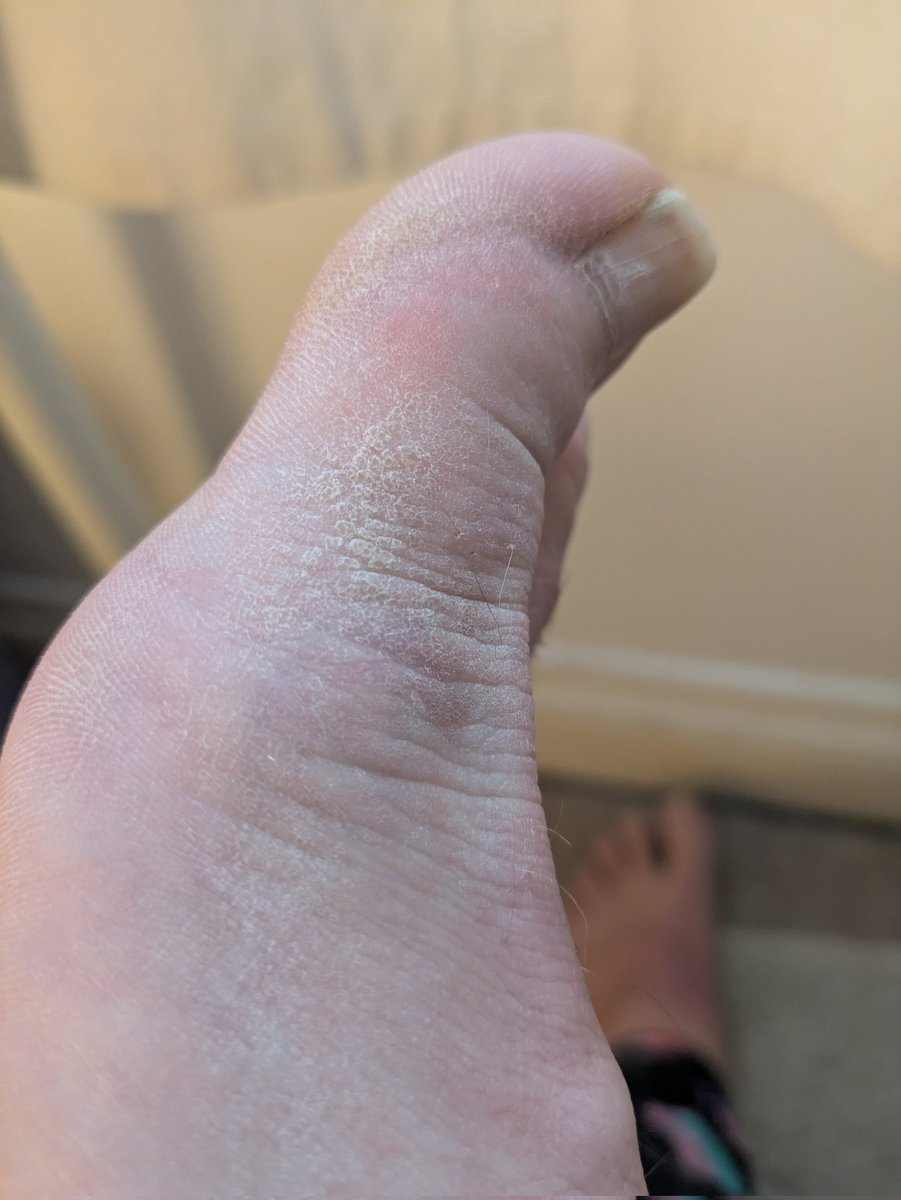 Some close ups of my dried out right foot. Need a full pedicure to remove all the dust