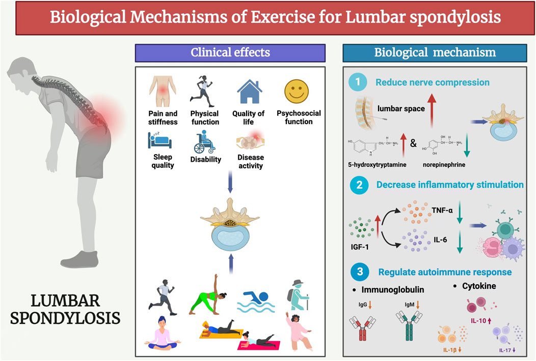 CorKinetic's tweet photo. Clinical effects and biological mechanisms of exercise on lumbar disc herniation

https://t.co/WkEbHDchMv https://t.co/vPzcZVAao1