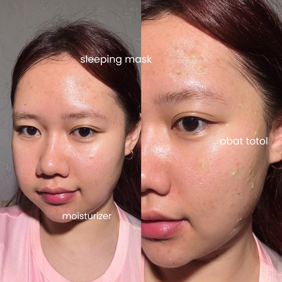 luluuys's tweet image. kalo jerawat udah mulai kasih kode mau numpang lahir, langsung tempelin ini aja‼️

this is my go-to moisturizer sekarang! bisa jadi moist, sleeping mask, sekaligus spot treatment. 😚✨