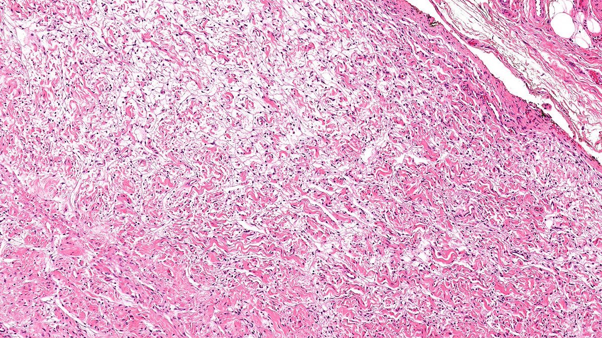 Case of Neurofibroma of Breast🔬

Neurofibroma shows bundles of bland spindle cells with wavy nuclei set in dense collagenous stroma. Sporadic neurofibroma of breast is exceptionally rare and more often associated with neurofibromatosis type 1.

#PathX #PathTwitter #breastpath
