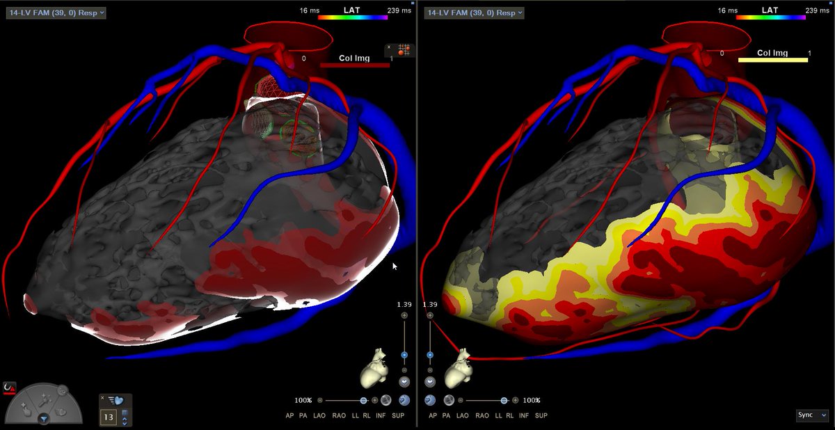 inheartmedical's tweet photo. Congratulations to Dr. Demetrio Castillo, MD and Dr. Fergie J. Losiniecki, MD on a successful redo VT ablation! By comparing the #inHEART 3D model with the prior electroanatomical map, target areas were identified with greater precision and efficiency. We're happy to have supported the procedure with inHEART imaging technology, which provided a clear visualization of wall thickness and transmural scar distribution across the endo, intra, and epicardial layers—helping to reduce mapping time and streamline the approach. A big thank you to mappers Tatum Cox and Claudia Mibelli for their valuable support!

@FergieLosiniec1 @mhshospital #epeeps #VTablation