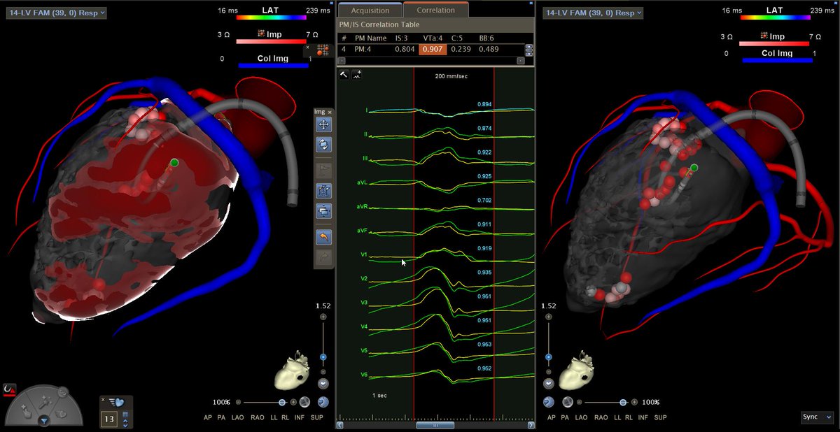 inheartmedical's tweet photo. Congratulations to Dr. Demetrio Castillo, MD and Dr. Fergie J. Losiniecki, MD on a successful redo VT ablation! By comparing the #inHEART 3D model with the prior electroanatomical map, target areas were identified with greater precision and efficiency. We're happy to have supported the procedure with inHEART imaging technology, which provided a clear visualization of wall thickness and transmural scar distribution across the endo, intra, and epicardial layers—helping to reduce mapping time and streamline the approach. A big thank you to mappers Tatum Cox and Claudia Mibelli for their valuable support!

@FergieLosiniec1 @mhshospital #epeeps #VTablation