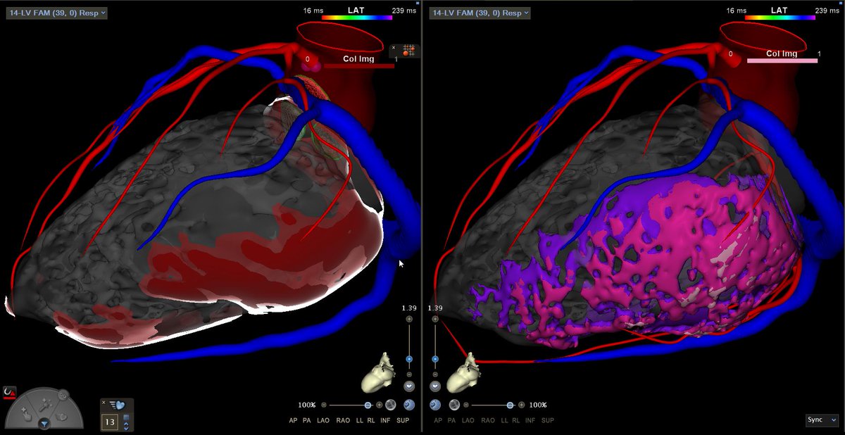 Congratulations to Dr. Demetrio Castillo, MD and Dr. Fergie J. Losiniecki, MD on a successful redo VT ablation! By comparing the #inHEART 3D model with the prior electroanatomical map, target areas were identified with greater precision and efficiency. We're happy to have