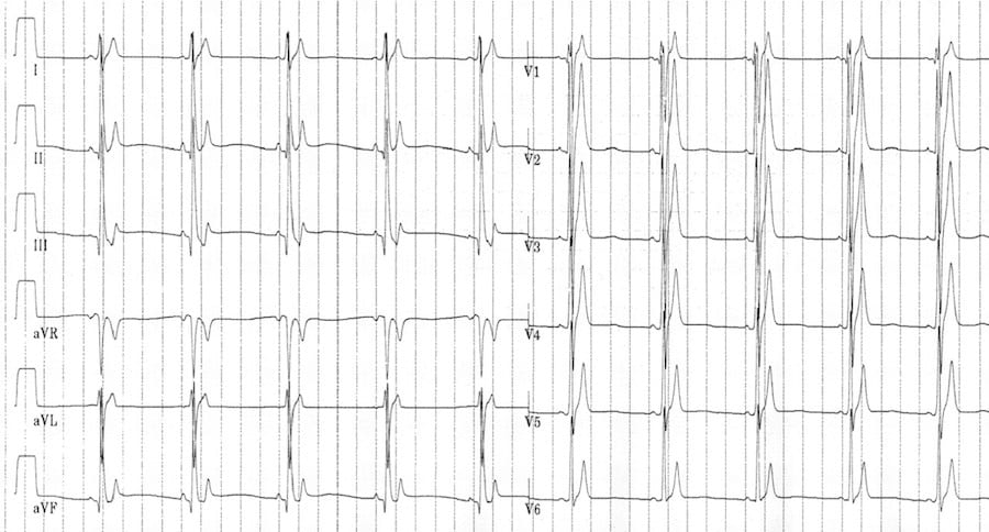 LITFL (@litflblog) on Twitter photo Rapid heartbeats and a family history of heart issues unravel an ECG enigma. Explore how an 18-year-old's ECG leads to a rare diagnosis, linking past and present.
litfl.com/flummoxing-fam…
#MedEd #MedTwitter #CardioTwitter #FOAMed Rapid heartbeats and a family history of heart issues unravel an ECG enigma. Explore how an 18-year-old's ECG leads to a rare diagnosis, linking past and present.
litfl.com/flummoxing-fam…
#MedEd #MedTwitter #CardioTwitter #FOAMed