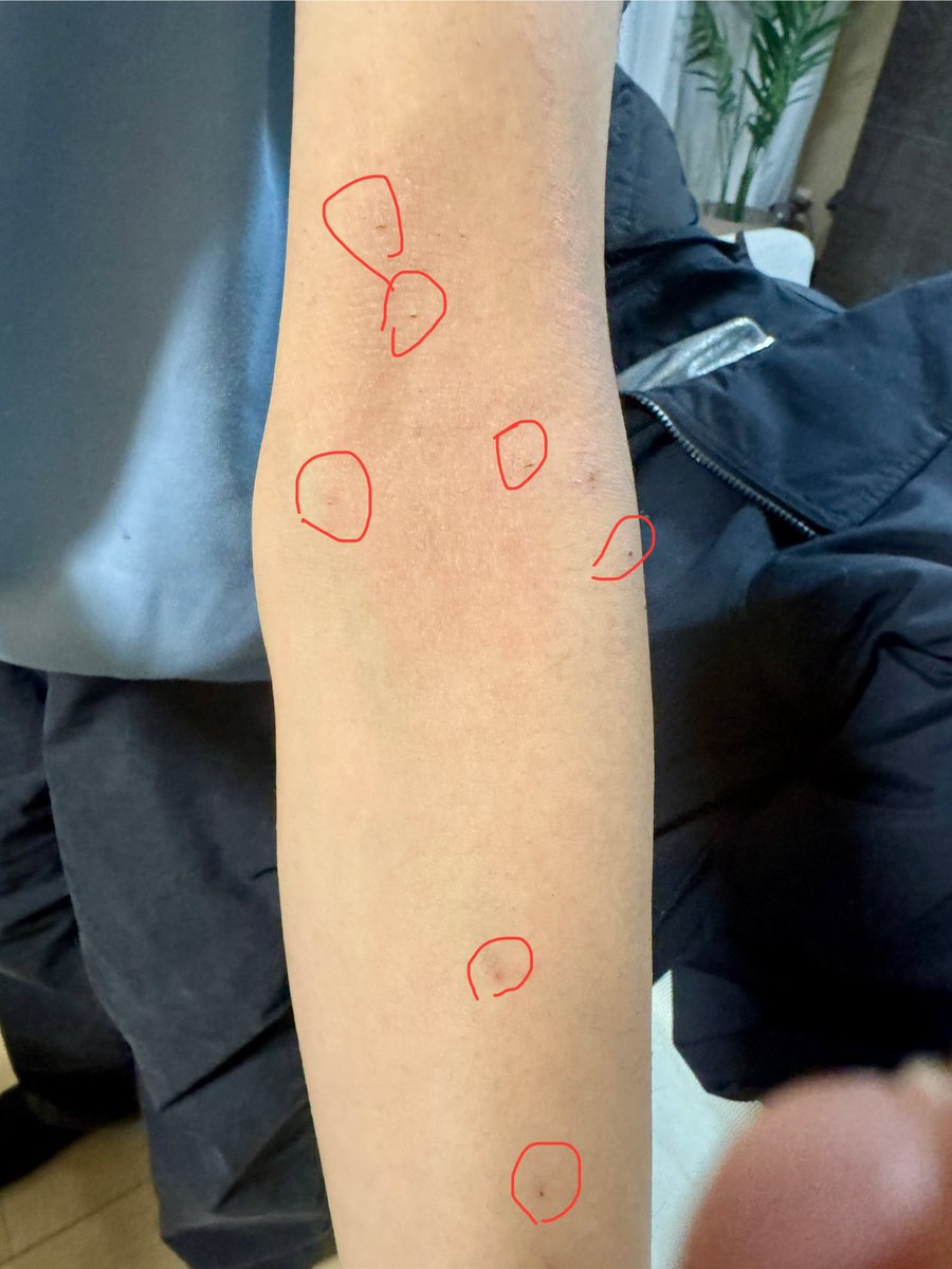 Tom7373's tweet photo. 酷い看護師
孫が病院で点滴を受ける際に6箇所にも針を刺されて、それも点滴の場所とも違う所に！どういうことですか？賠償は？ https://t.co/zqmAQ1TnLw