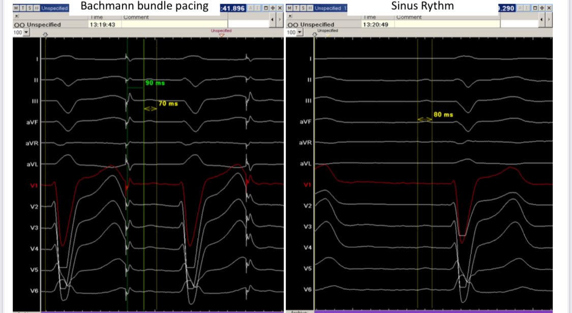 Manuel Molina-Lerma (@manolomolina8) on Twitter photo An other case of bachmann bundle pacing in a sick sinus síndrome patient. Note a narrower paced p wave compared to native p wave. A long spike-p wave interval. We are reducing the likelyhood of atrial arrhythmias! <a href="/ValverdeSoria/">Laura Valverde Soria</a> <a href="/ritmo_SEC/">Asociación del Ritmo Cardiaco</a> <a href="/DanielLustgart4/">Daniel Lustgarten</a> An other case of bachmann bundle pacing in a sick sinus síndrome patient. Note a narrower paced p wave compared to native p wave. A long spike-p wave interval. We are reducing the likelyhood of atrial arrhythmias! <a href="/ValverdeSoria/">Laura Valverde Soria</a> <a href="/ritmo_SEC/">Asociación del Ritmo Cardiaco</a> <a href="/DanielLustgart4/">Daniel Lustgarten</a>