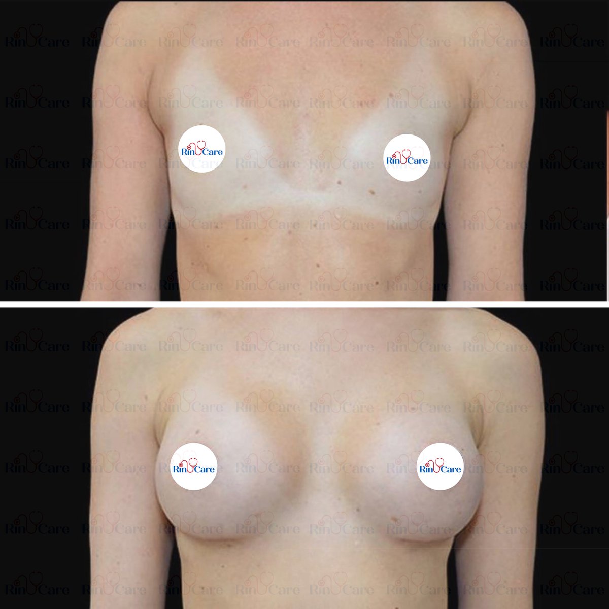 rinucare's tweet photo. #BreastAugmentation #BreastImplants #BoobJob #BreastSurgery #BreastAugmentationResults #BreastEnhancement #BreastAugmentationJourney #BreastAugmentationBeforeAndAfter #BreastImplantRecovery #BoobGoals #BreastAugmentationTurkey #TurkeyBreastAugmentation #BreastSurgeryInTurkey https://t.co/I5Lx1MxCfa