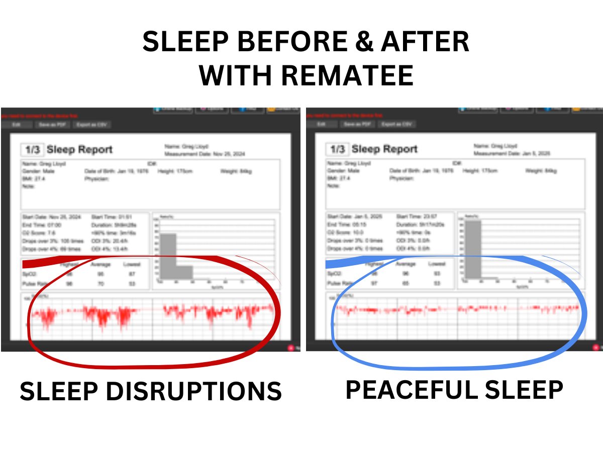 Rematee's tweet image. 😴 Greg’s snoring was ruining his sleep—until he took control. Using a Bumper Belt + mouthpiece, he saw real improvements in his sleep data! 📊💤

Track your sleep &amp;amp; find solutions that work? Read Greg's journey here: rematee.com/blogs/lets-get…

#SnoringSolutions #SleepApnea #sleep