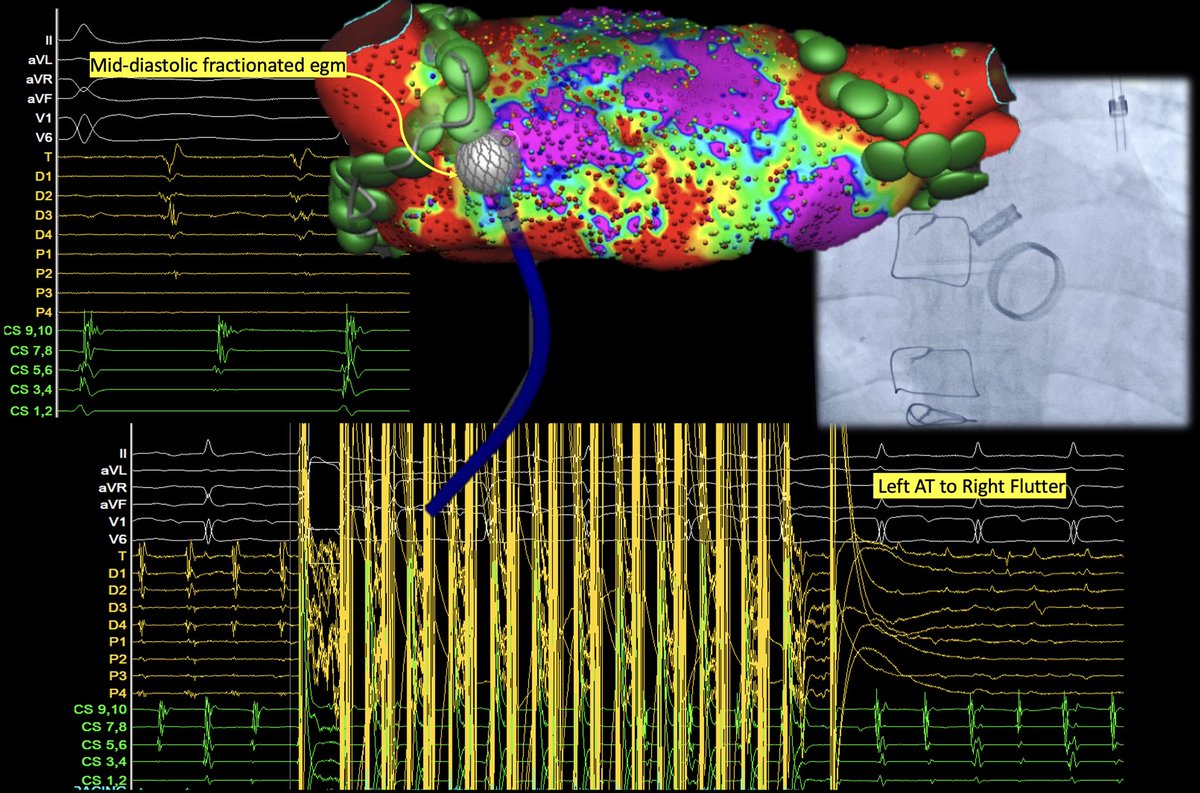 Michail Efremidis (@mefraimidis) on Twitter photo A young patient with mechanical aortic and mitral valves presented with atrial tachycardia (AT). The AFFERA system was utilized for mapping and ablation, successfully converting AT to CTI AFL
<a href="/SteliosDragasis/">Stelios</a> <a href="/ipetemil/">Panagiotis Mililis</a> <a href="/athsaplaouras/">Athanasios Saplaouras</a> <a href="/Kariki_O/">Ourania Kariki</a> <a href="/K_Letsas/">Konstantinos Letsas</a> <a href="/PetrosSkalidis/">Petros Skalidis</a> #EPeeps A young patient with mechanical aortic and mitral valves presented with atrial tachycardia (AT). The AFFERA system was utilized for mapping and ablation, successfully converting AT to CTI AFL
<a href="/SteliosDragasis/">Stelios</a> <a href="/ipetemil/">Panagiotis Mililis</a> <a href="/athsaplaouras/">Athanasios Saplaouras</a> <a href="/Kariki_O/">Ourania Kariki</a> <a href="/K_Letsas/">Konstantinos Letsas</a> <a href="/PetrosSkalidis/">Petros Skalidis</a> #EPeeps