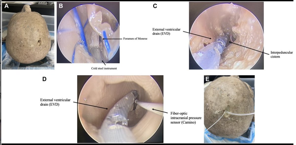 Neurosurgery Publications (@neurosurgerycns) on Twitter photo #ONSNew Development and Validation of a Novel Human-Fixed Cadaveric Model Reproducing Cerebrospinal Fluid Circulation for Simulation of Endoscopic Endonasal Skull Base Surgery bit.ly/3Qfz4vM by Gosselin et al <a href="/universitelaval/">Université Laval</a> <a href="/MdOlabisi/">Olabisi Sanusi MD, FAANS</a> <a href="/CNS_Update/">CNS</a> #ONSNew Development and Validation of a Novel Human-Fixed Cadaveric Model Reproducing Cerebrospinal Fluid Circulation for Simulation of Endoscopic Endonasal Skull Base Surgery bit.ly/3Qfz4vM by Gosselin et al <a href="/universitelaval/">Université Laval</a> <a href="/MdOlabisi/">Olabisi Sanusi MD, FAANS</a> <a href="/CNS_Update/">CNS</a>