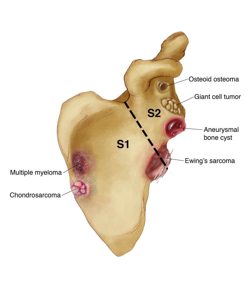 ctisus's tweet photo. Scapular Tumors https://t.co/Vb6NeC4VeY