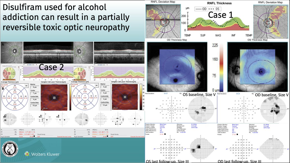 Disulfiram-Induced Optic Neuropathy: A Case Series and Review of Literature: Journal of Neuro-Ophthalmology
Article: bit.ly/JNO_Disulfiram
 #brain #eye #vision #research #Neurology #NeuroOphth #Ophthalmology #Medicine #addiction #toxic <a href="/DrewCareyMD/">Drew Carey, Eye MD</a> <a href="/HopkinsMedicine/">Johns Hopkins Medicine</a>