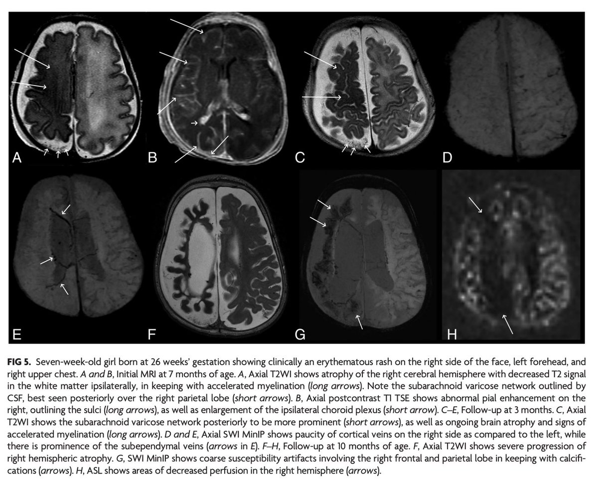 AJNR (@theajnr) on Twitter photo "Alternative Venous Pathways: A Potential Key Imaging Feature for Early Diagnosis of Sturge-Weber Syndrome Type 1"
doi.org/10.3174/ajnr.A…
<a href="/crcerron/">Carmen Cerron-Vela</a>; <a href="/CHOPRadiology/">CHOP Radiology</a> #FellowsJournalClub "Alternative Venous Pathways: A Potential Key Imaging Feature for Early Diagnosis of Sturge-Weber Syndrome Type 1"
doi.org/10.3174/ajnr.A…
<a href="/crcerron/">Carmen Cerron-Vela</a>; <a href="/CHOPRadiology/">CHOP Radiology</a> #FellowsJournalClub