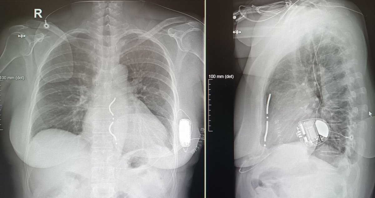 ArritmiasNegrin's tweet photo. 💪🏽CASO CLÍNICO

🙋🏻‍♀️Paciente con MCH e implante reciente de #AURORAEVICD 🛟 en prevención 1aria en nuestro centro🏥

🧐Me sorprende esto a la interrogación...

🤔Qué problema hay y cómo lo puedo solucionar?

👀Te añadimos también el TAC porque la anatomía es VITAL https://t.co/PIxclcKBX5