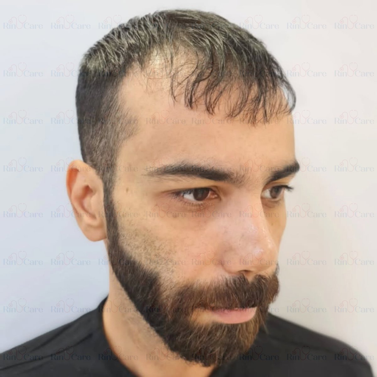 rinucare's tweet photo. #HairTransplant #FueHairTransplant #HairRestoration #HairRegrowth #HairTransformation #HairTransplantTurkey #ShavelessHairTransplant #NaturalHairline #HairLossTreatment #BeforeAndAfterHair #NoShaveHairTransplant #HairTransplantIstanbul #TurkeyHairClinic #TurkeyHairJourney https://t.co/anbKznGCnA