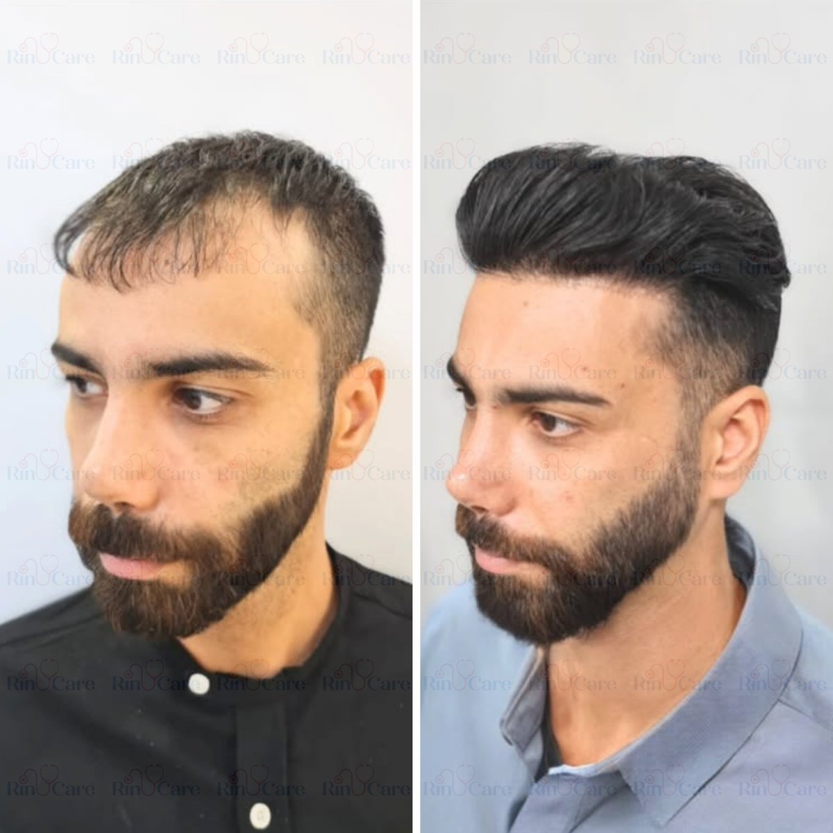 rinucare's tweet photo. #HairTransplant #FueHairTransplant #HairRestoration #HairRegrowth #HairTransformation #HairTransplantTurkey #ShavelessHairTransplant #NaturalHairline #HairLossTreatment #BeforeAndAfterHair #NoShaveHairTransplant #HairTransplantIstanbul #TurkeyHairClinic #TurkeyHairJourney https://t.co/anbKznGCnA